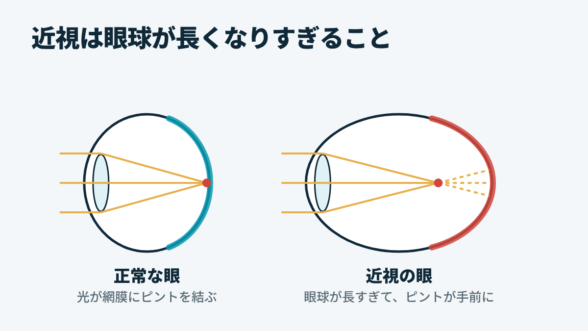 正常な目と、長く伸びた近視の眼球を比較した図